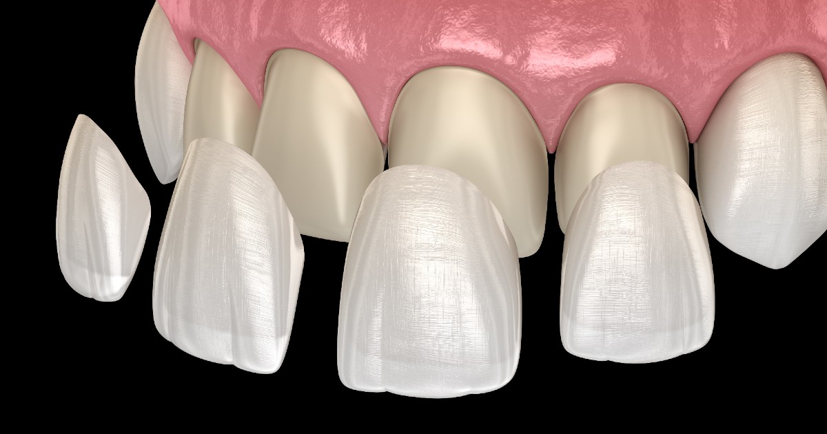 Dental veneers